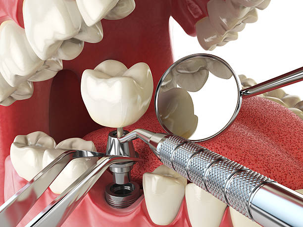 Best Lost Filling or Crown Replacement in Perth Amboy, NJ